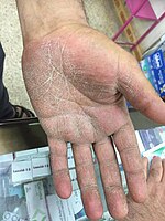 Tinea manuum (one hand)