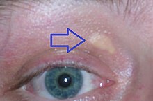 Xanthelasma palpebrarum, yellowish patches consisting of cholesterol deposits above the eyelids. These are more common in people with familial hypercholesterolemia. Xanthelasma palpebrarum.jpg