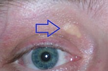 Xanthelasma palpebrarum.jpg