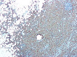 صورة مجهرية لإلْتِهابُ الحُوَيضَةِ والكُلْيَةِ الوَرَمِيُّ الحُبَيبِيُّ الأَصْفَر يتبين من CD68 المناعي.