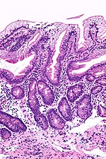 Thumbnail for Porodična hipobetalipoproteinemija
