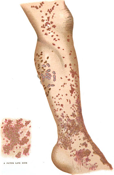 File:An introduction to dermatology (1905) Lichen planus 1.jpg