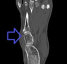 cuboid fracture healing