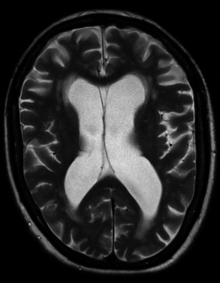 <span class="mw-page-title-main">Vascular dementia</span> Dementia resulting from stroke