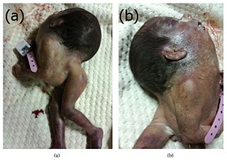 Iniencephaly is a rare type of cephalic disorder characterised by three common characteristics: a defect to the occipital bone, spina bifida of the cervical vertebrae and retroflexion of the head on the cervical spine. Stillbirth is the most common outcome, with a few rare examples of live birth, after which death almost invariably occurs within a short time.