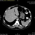 CT snímka žalúdka