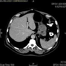 CT image of a GIST in the gastric cardia. The lesion appears submucosal, is hypervascular and protrudes intraluminally. Upper GI bleeding led to endoscopy, finding an ulcerated mass. CT image of a GIST tumor in the gastric cardia.jpg