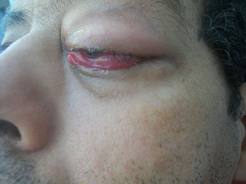 File:Celulitis ocular izq.JPG