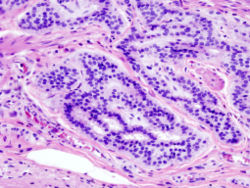 24 December 2012: British medical researchers discover two genes that are thought to greatly increase the risk of bowel cancer (carcinoid pictured). Colonic carcinoid (1) Endoscopic resection.jpg