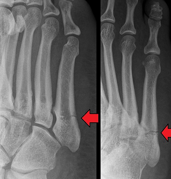 File:Cropped version of Jonesfracture.jpg