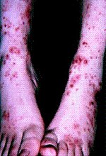 Thumbnail for Lupus vasculitis