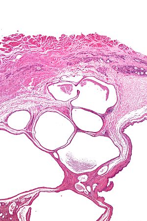 Cystic tumour of the atrioventricular nodal region - very low mag.jpg