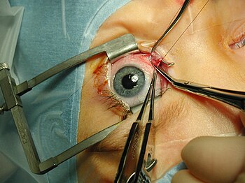 Strabismus surgery