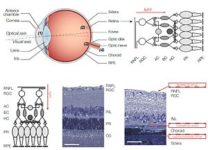 Diagram of the eye and placement of the retinal implants.jpg