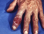 Extragenital syphilitic chancre of the left index finger PHIL 4147 lores.jpg