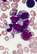 Miniatura per Leucemia promielocitica acuta