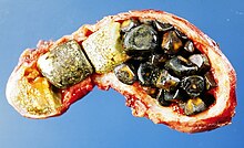 Gallstones in a gall bladder Gallstones.jpg