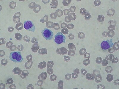 Hairy cell leukemia: Abnormal B cells look "hairy" under a microscope because of radial projections from their surface.