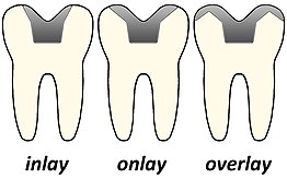 Structure of dental inlays and onlays Inlay onlay overlay.jpg