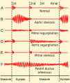Phonocardiograms from normal and abnormal heart sounds.svg