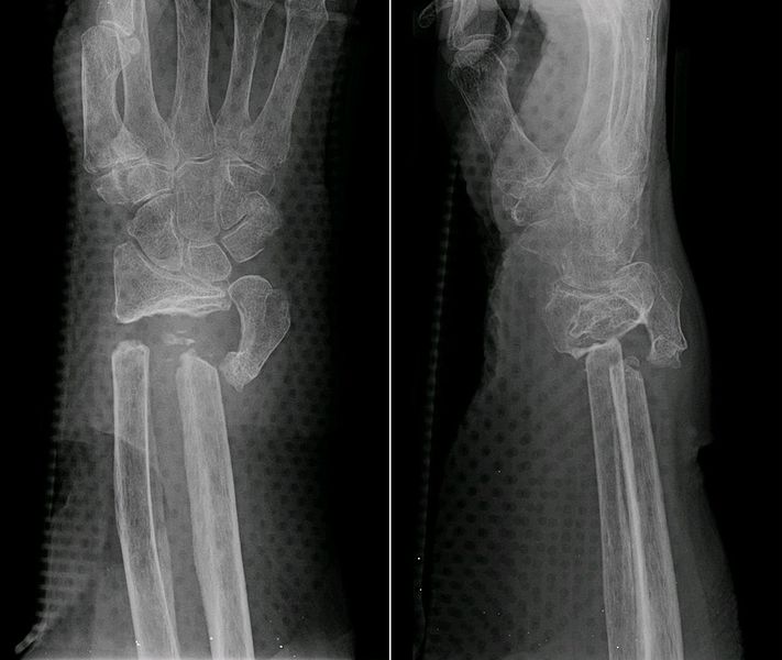 File:Pseudarthrosis Wrist jmn.jpg