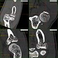 Radial head fracture - Wikipedia