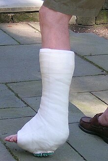 Orthopedic cast - Wikipedia