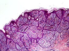 Nevoid melanoma Skin Tumors-P6231204.jpg