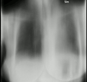 Tomosynthesis of chronic fibrosing pulmonary aspergillosis.gif