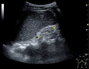 Ultrasonography of end-stage chronic kidney disease.jpg