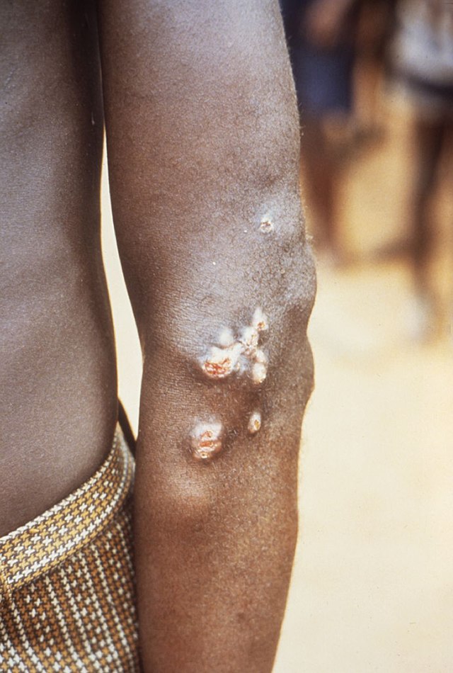 File:Scars of yaws lesions on the legs of a female patient with a