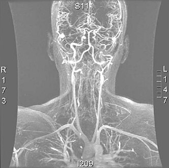 Angio MRI of supra-aortic vessels after the injection of 20cc of gadolinium for contrast