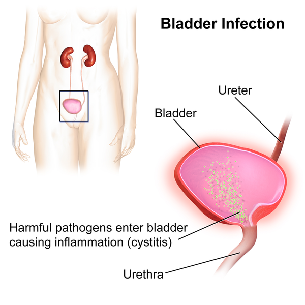 קובץ:Bladder Infection.png