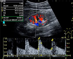 Renal ultrasonography using duplex technique of a normal adult kidney, with the estimation of the systolic velocity (Vs), the diastolic velocity (Vd), acceleration time (AoAT), systolic acceleration (Ao Accel) and resistive index (RI). Red and blue colors in the color box represent flow towards and away from the transducer, respectively. The spectrogram below the B-mode image shows flow velocity (m/s) against time (s) obtained within the range gate. The small flash icons on the spectrogram represent initiation of the flow measurement. Doppler ultrasound of systolic velocity (Vs), diastolic velocity (Vd), acceleration time (AoAT), systolic acceleration (Ao Accel) and resistive index (RI) of normal kidney.jpg