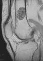 Enchondrom femuru MRI