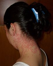 Euproctis Chrysorrhoea skin rash.jpg