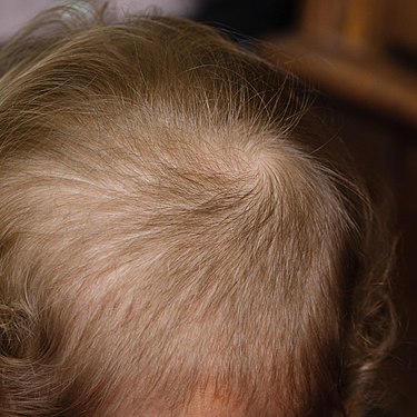 Hair swirl on a toddler