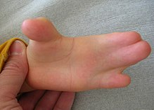 Hand in Apert syndrome with syndactyly Hand in Apert syndrome (1).JPG