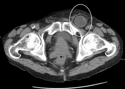 An incarcerated inguinal hernia as seen on cross sectional CT scan