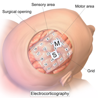 <span class="mw-page-title-main">Electrocorticography</span> Type of electrophysiological monitoring