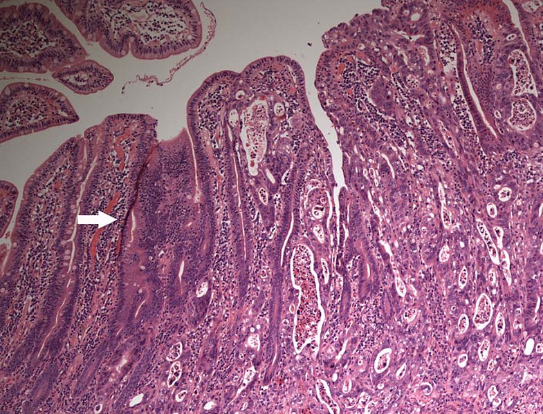 File:Light microscopy of small intestinal adenocarcinoma.jpg