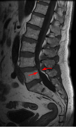 Lumbar Spinal Stenosis MRI