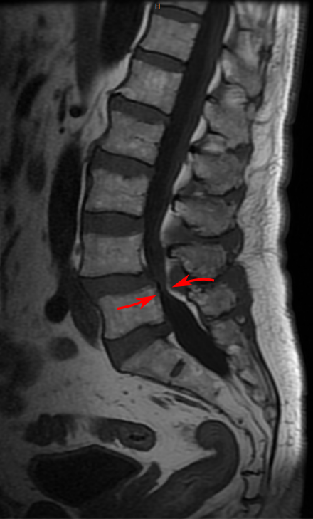 MRI of a lumbar spinal stenosis L4-L5