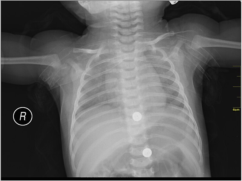 File:Medical X-Ray imaging VDT07 nevit.jpg