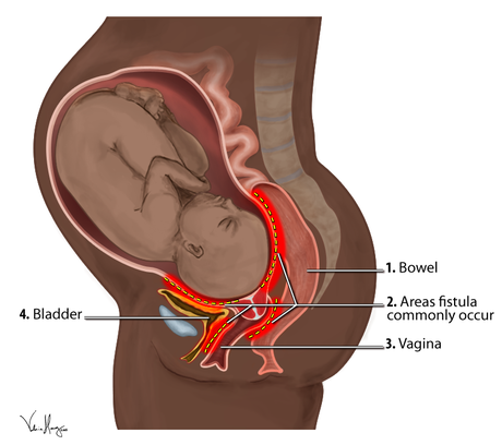 Fístula obstétrica