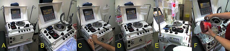 File:Platelet apheresis.jpg