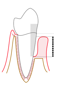 Periodontal pocket depth measured by a periodontal probe Severe periodontitis.png