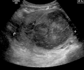 A very large (9 cm) fibroid of the uterus which is causing pelvic congestion syndrome as seen on ultrasound