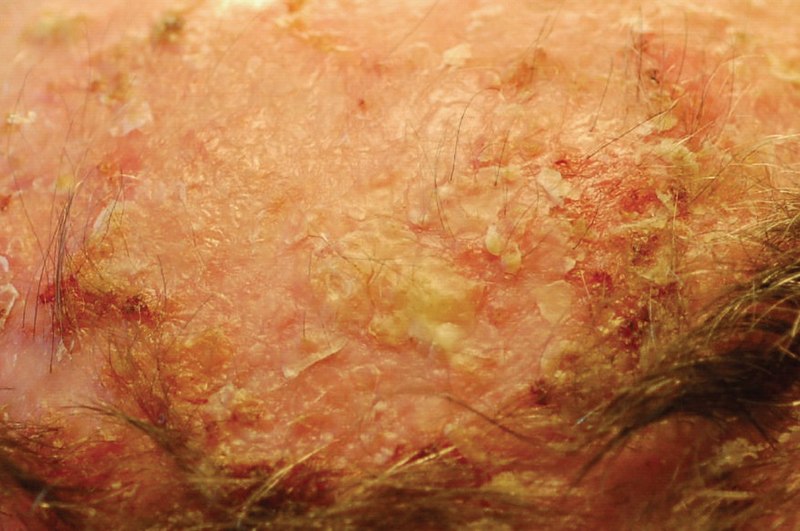 File:Actinic keratosis of the scalp.jpg