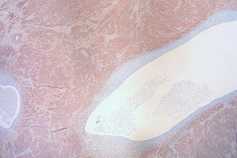 File:Adenomyoma of the Ovary (Smooth Muscle Actin Immunostain) (4974731463).jpg